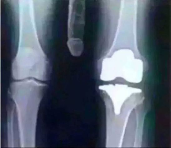 knee x-ray.jpg