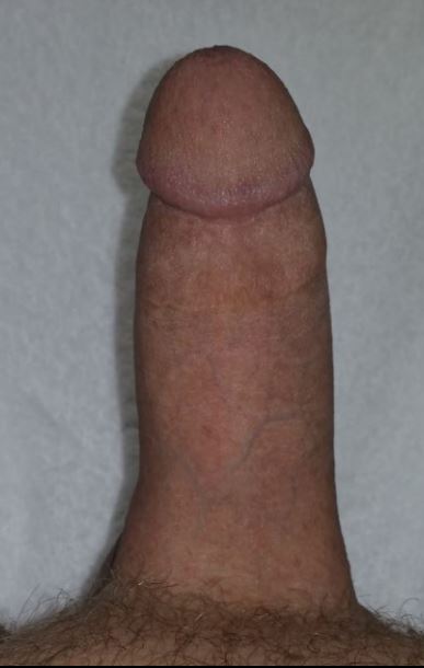 Implant Erect Top View.JPG