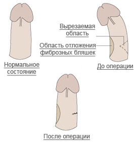 klassicheskaya-operaciya-bolezn-peironi.jpg