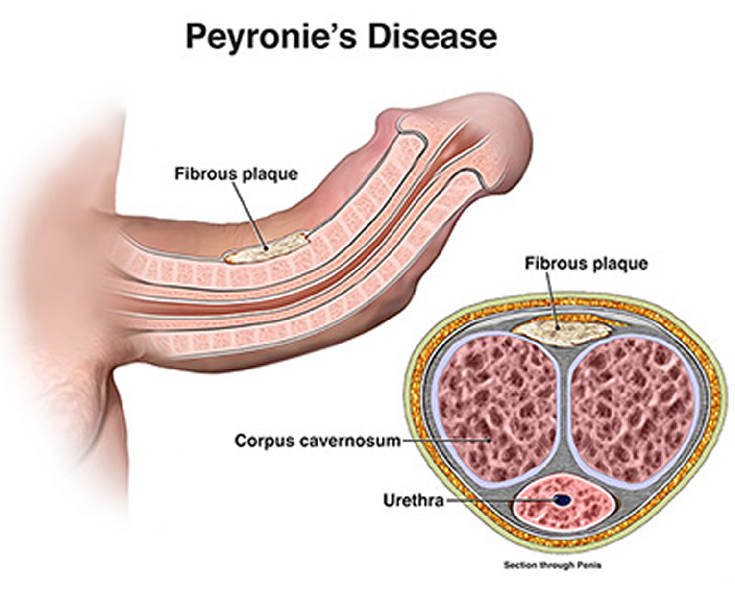 peyronies-disease.jpg