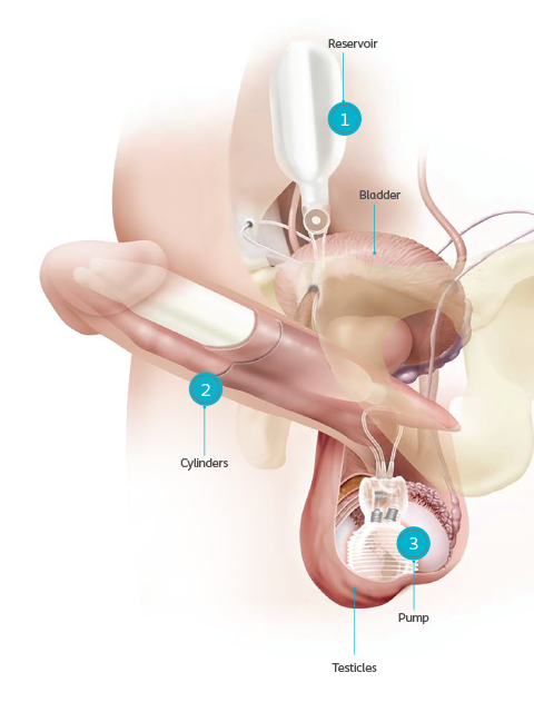 Diagram of Titan implant.png