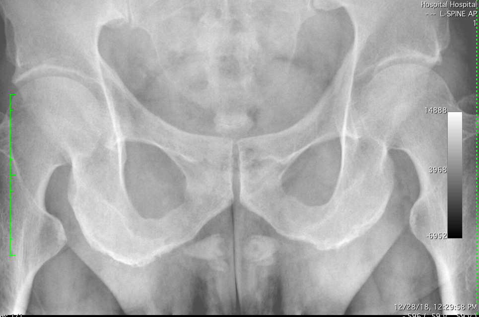 hips xray titan.png