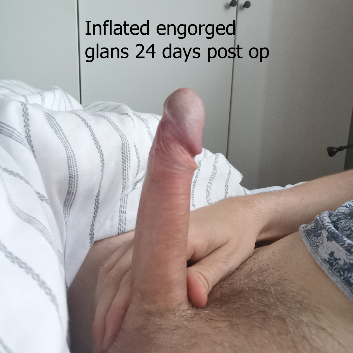 Inflated side engorged glans 24 days post op.jpg